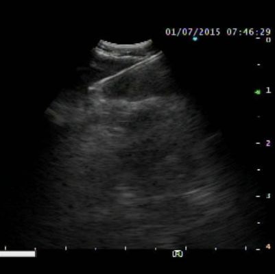 Expect™ Pulmonary-Endobronchial Ultrasound Transbronchial Aspiration Needle